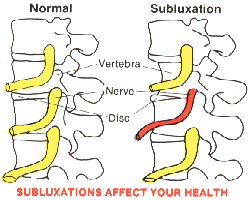 subluxation